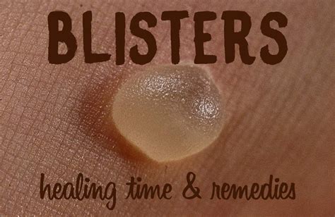 Can you speed up blister healing?