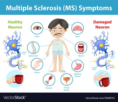 Can you stop MS if you catch it early?