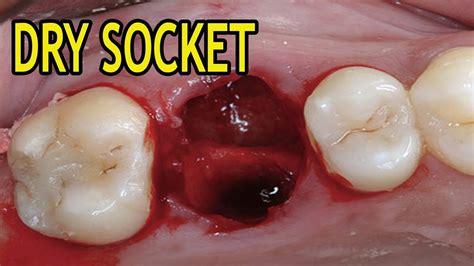 Can you stop a dry socket from forming?