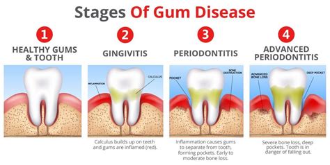 Can you stop stage 3 periodontitis?