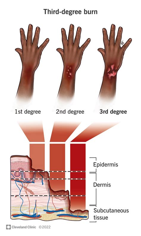 Can you survive 100% 3rd degree burns?