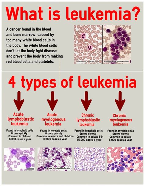 Can you survive leukemia if caught early?