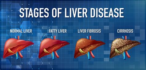 Can you survive stage 3 liver disease?