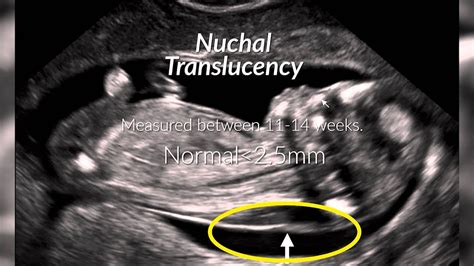 Can you tell if baby has Down syndrome in ultrasound?