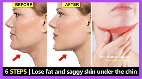 Can you tighten skin under chin?