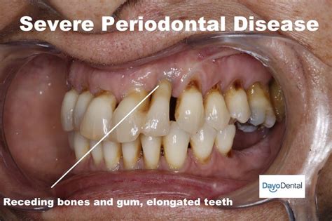 Can you treat stage 4 periodontal disease?