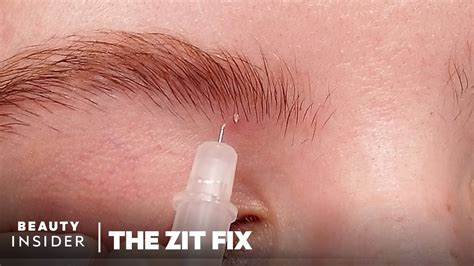 Can you use a needle to pop a blind pimple?