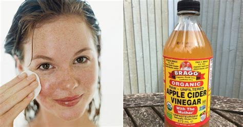 Can you use apple cider vinegar on your face?