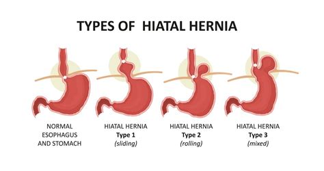 Can you visually see a hiatal hernia?