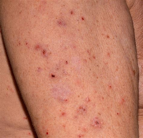 Can you visually see scabies?