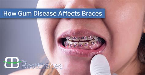Can you wear braces if you have gum disease?