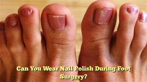 Can you wear nail polish on your toes during surgery?