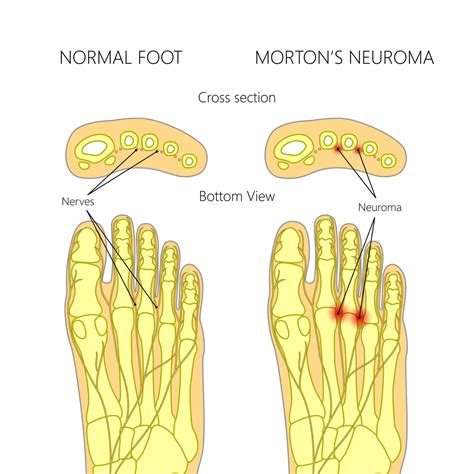 Can you work with Morton's neuroma?