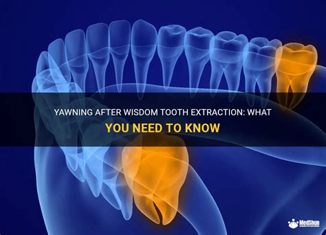 Can you yawn after wisdom teeth removal?
