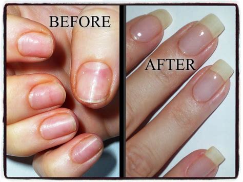 Can your nails be healthy after acrylics?