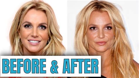 Did Britney get lip fillers?