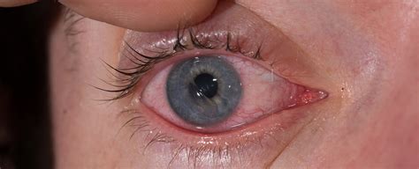 Did I damage my cornea?