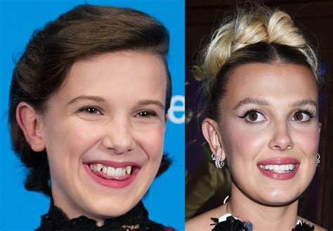 Did Millie get her teeth fixed?