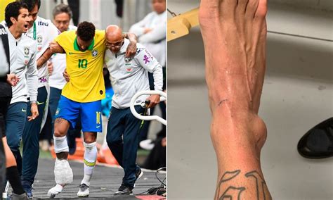 Did Neymar do a surgery?