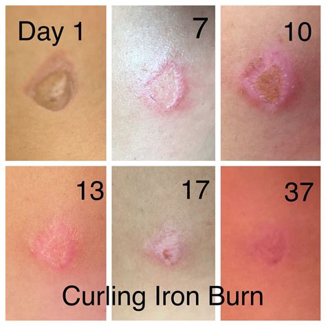 Do 2nd degree burn scars go away?