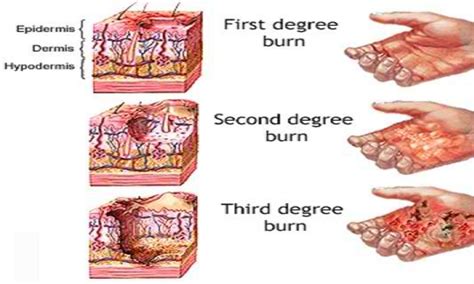 Do 3rd degree burns hurt forever?