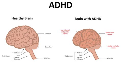 Do ADHD brains develop slower?
