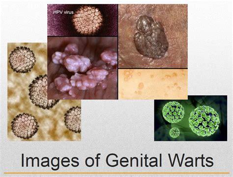 Do HPV warts discharge?