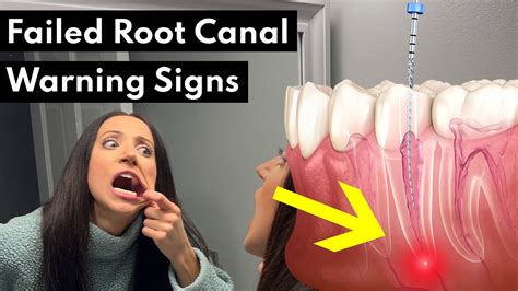 Do I have to pay if my root canal fails?