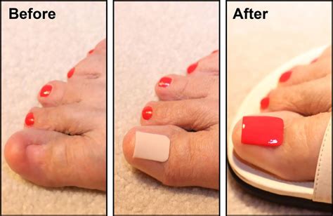Do I need to remove toenail polish before surgery?