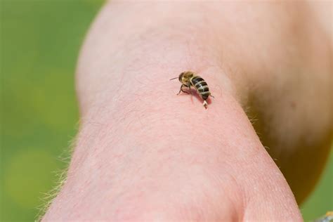 Do I need to see a doctor for bee sting?