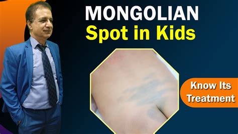 Do Jews have Mongolian spots?