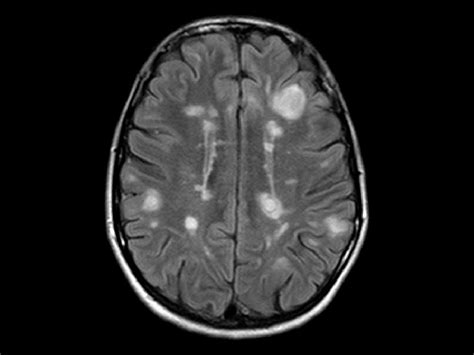 Do MS brain lesions heal?