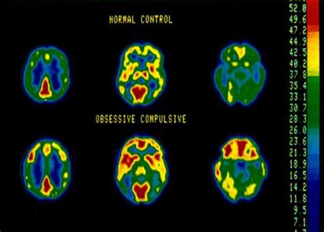 Do OCD brains look different?