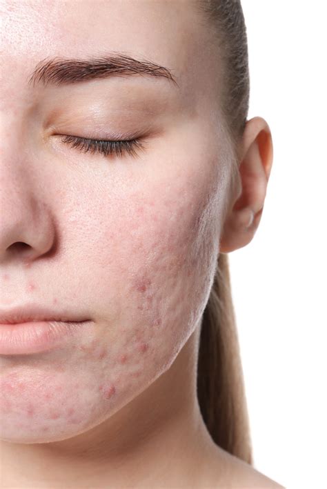 Do acne scars ever leave?