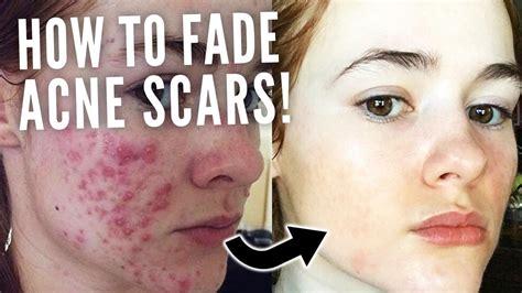 Do acne scars fade?