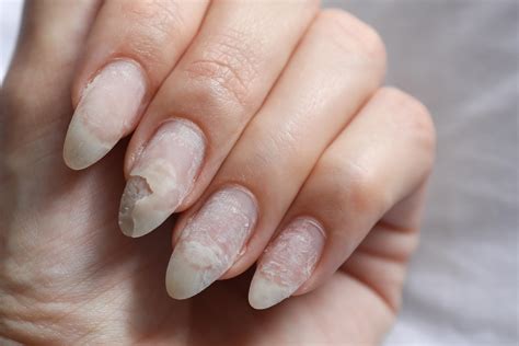 Do acrylic nails cause permanent damage?