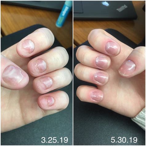Do acrylics damage your nails?