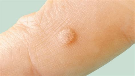 Do all people with HPV 6 get warts?