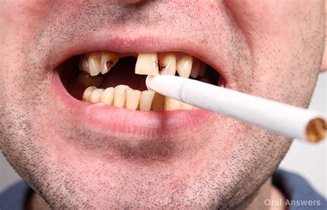 Do all smokers have yellow teeth?