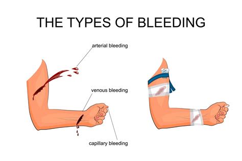 Do arrows cause bleeding?