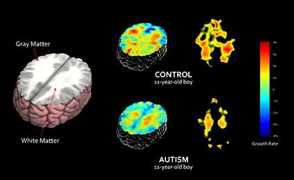 Do autistic brains develop slower?