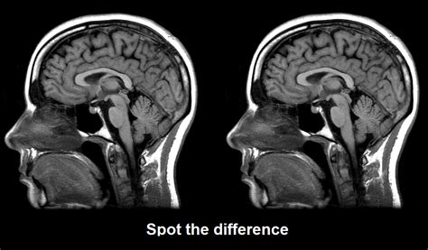 Do autistic brains look different?