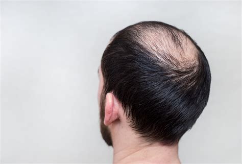 Do bald men live less?