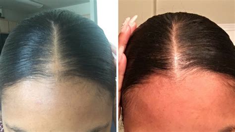 Do bald spots from extensions grow back?