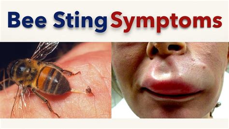 Do bee stings affect you?