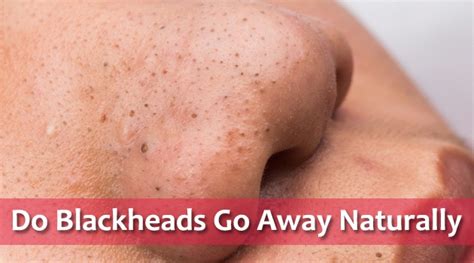 Do blackheads go away naturally?