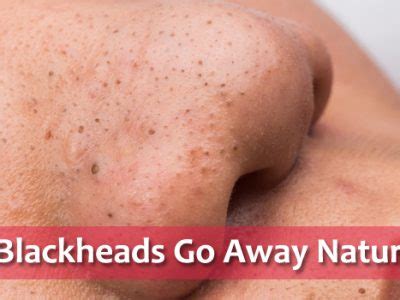 Do blackheads naturally go away?
