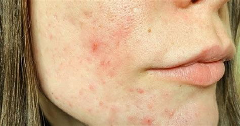 Do blind pimples leave scars?