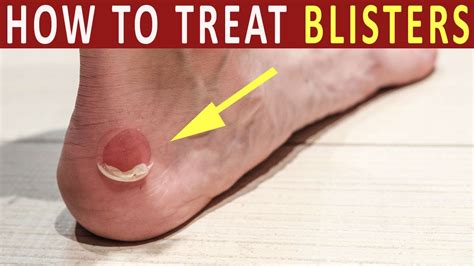 Do blisters go away overnight?