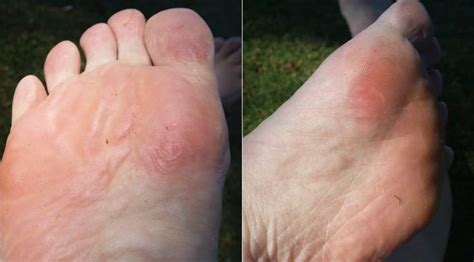 Do blisters heal faster covered or uncovered?